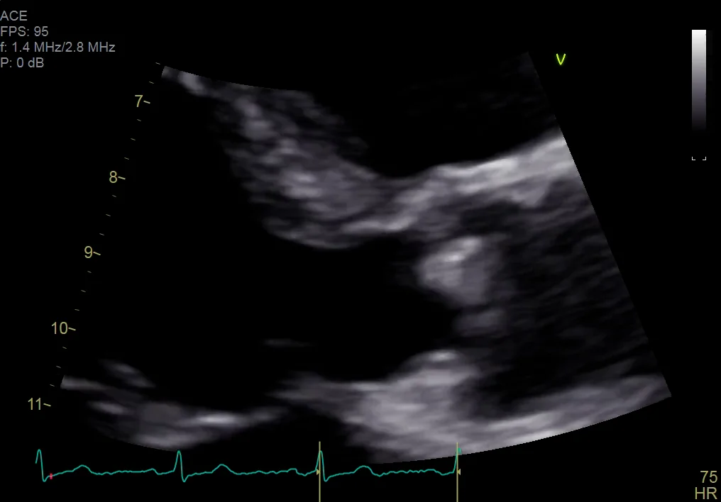 Vid 1_Leaflet thickening & restricted systolic opening trileaflet AV ...