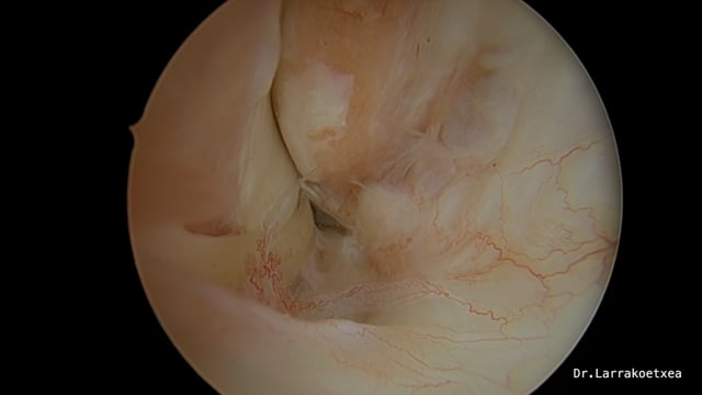 Reparación all-inside del ligamento peroneoastragalino anterior