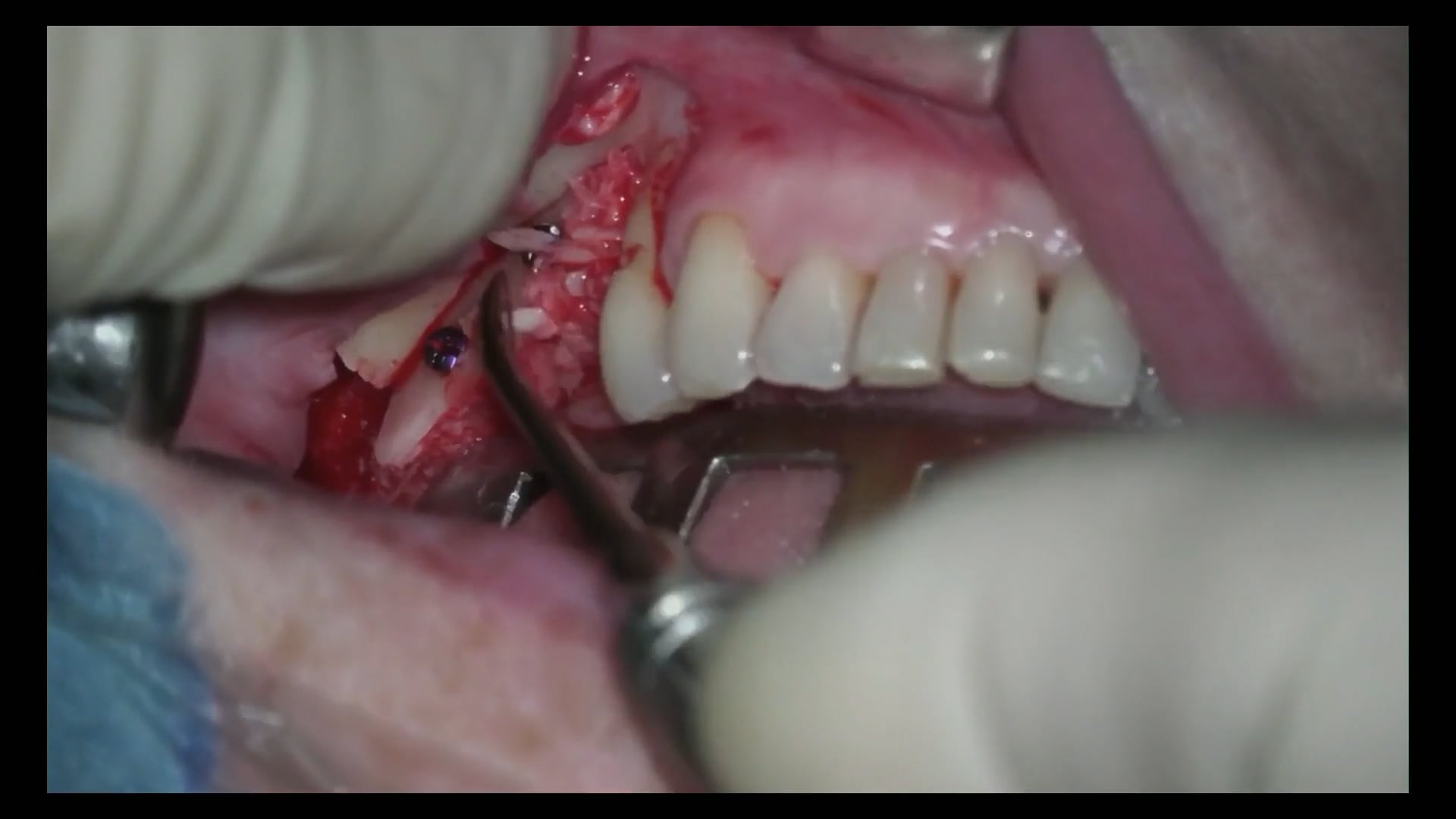 Injerto en rama mandibular con hueso autógeno y aloinjerto cortical
