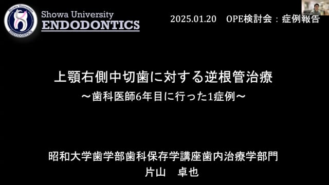 上顎右側中切歯に対する逆根管治療～歯科医師6年目に行った1症例～｜片山卓也先生(Topics)