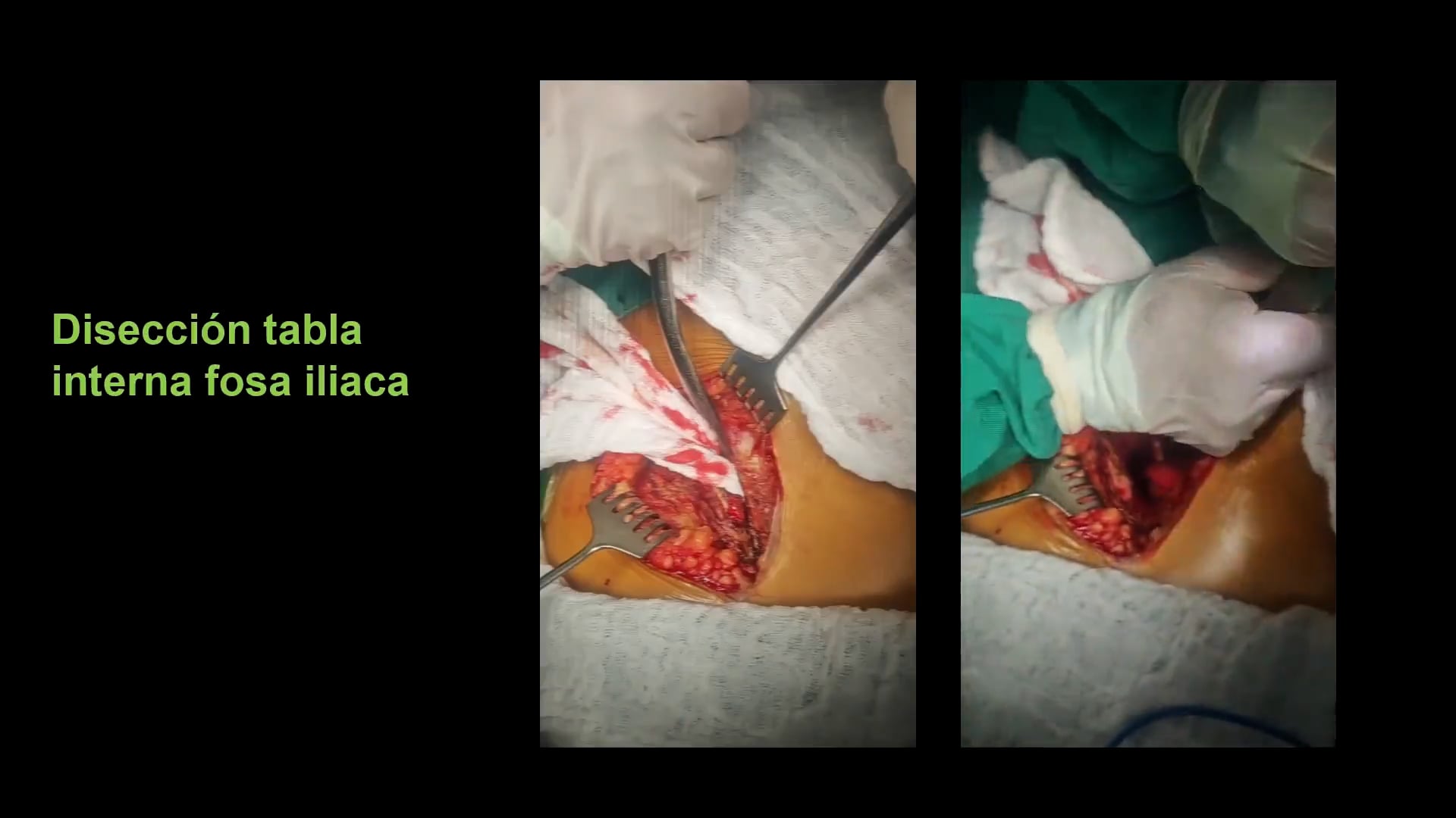 Técnicas Quirúrgicas para Osteotomía Acetabular