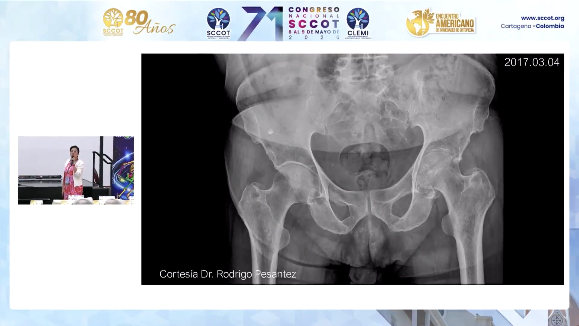Fractura Acetabular en Paciente Mayor