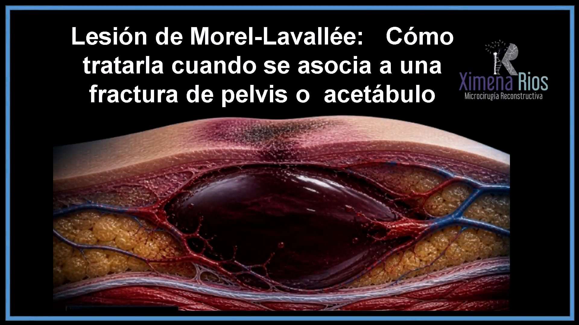 Lesiones de Morel-Lavallée: Fisiopatología y Manejo