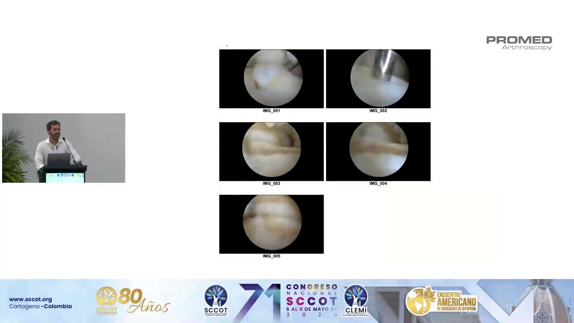 Andamios para Lesiones Osteocondrales del Astrágalo