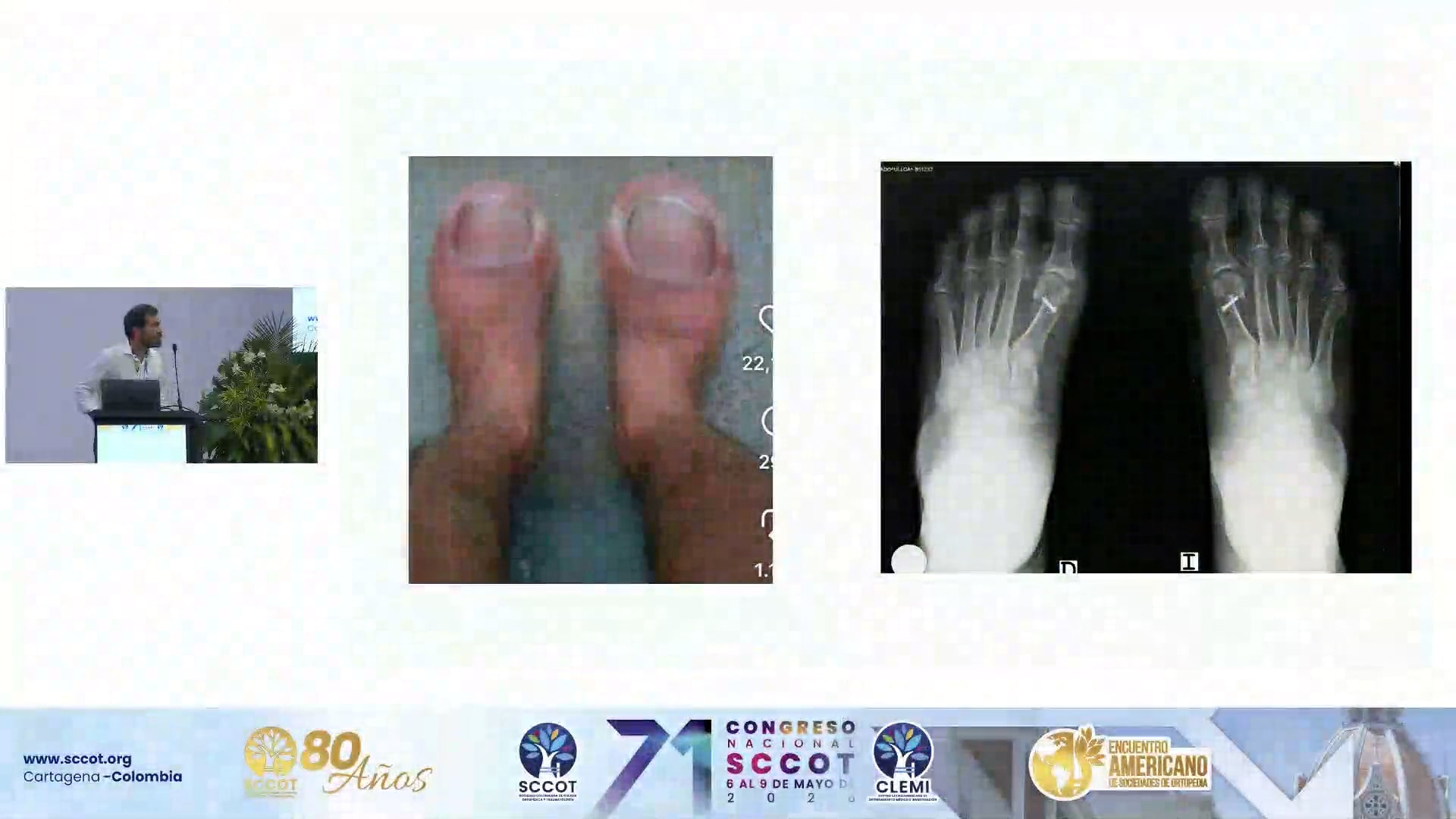 Curva de Aprendizaje Cirugía Hallux Valgus