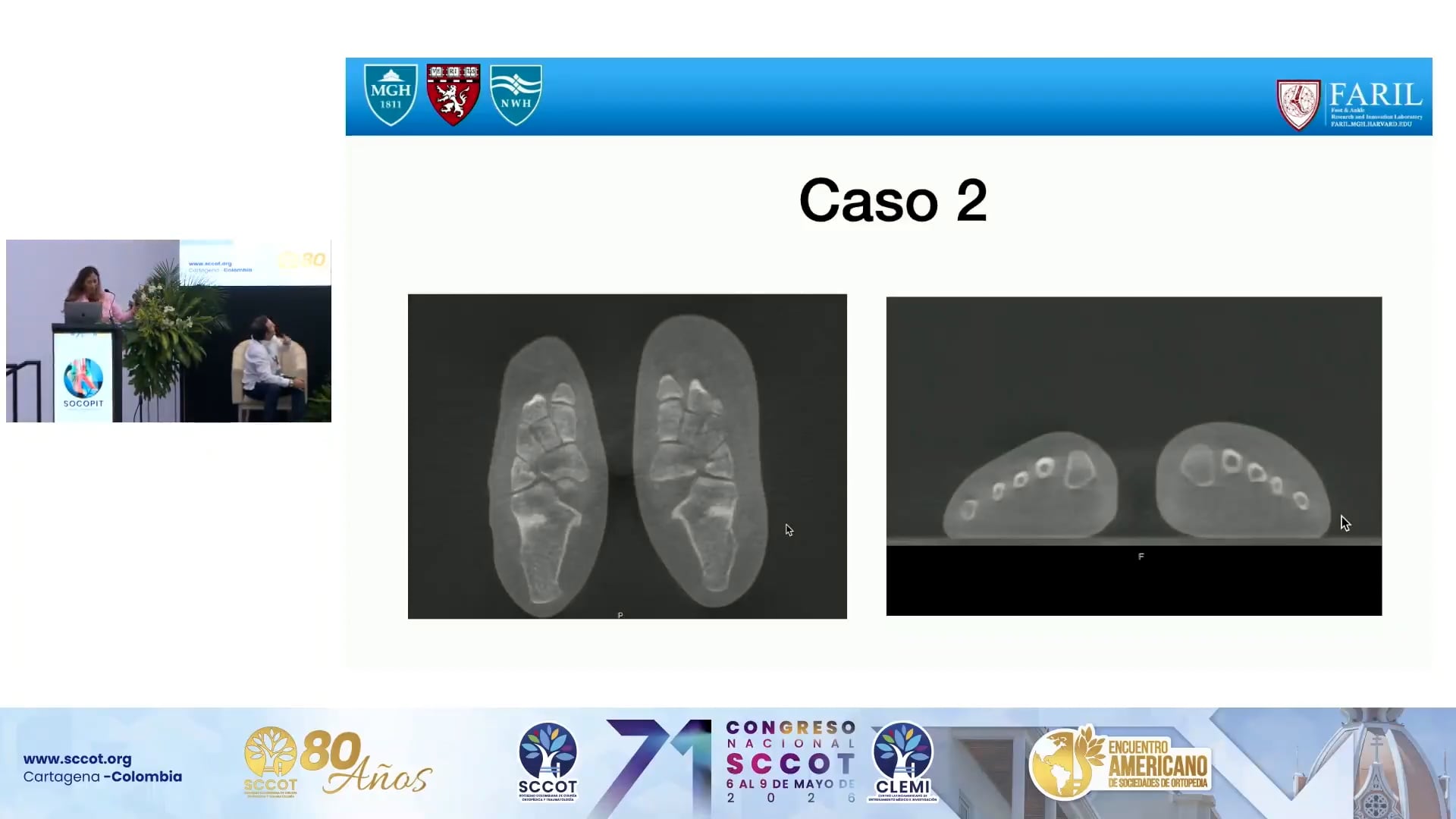 IA para Inestabilidad Lisfranc
