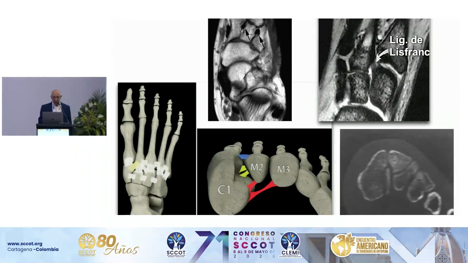 Anatomía y Manejo de Lisfranc