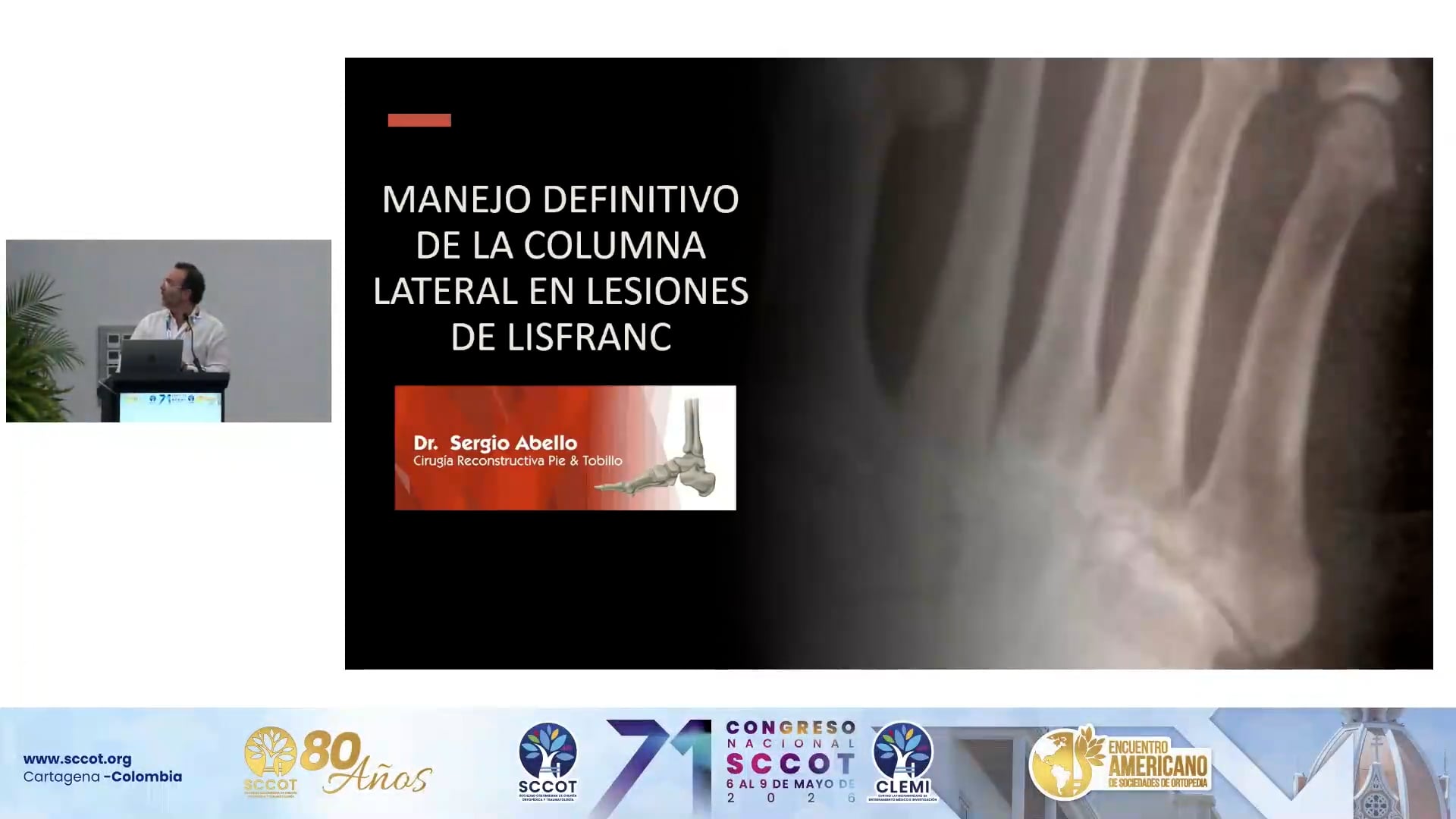 Manejo Integral de Lesiones de Lisfranc