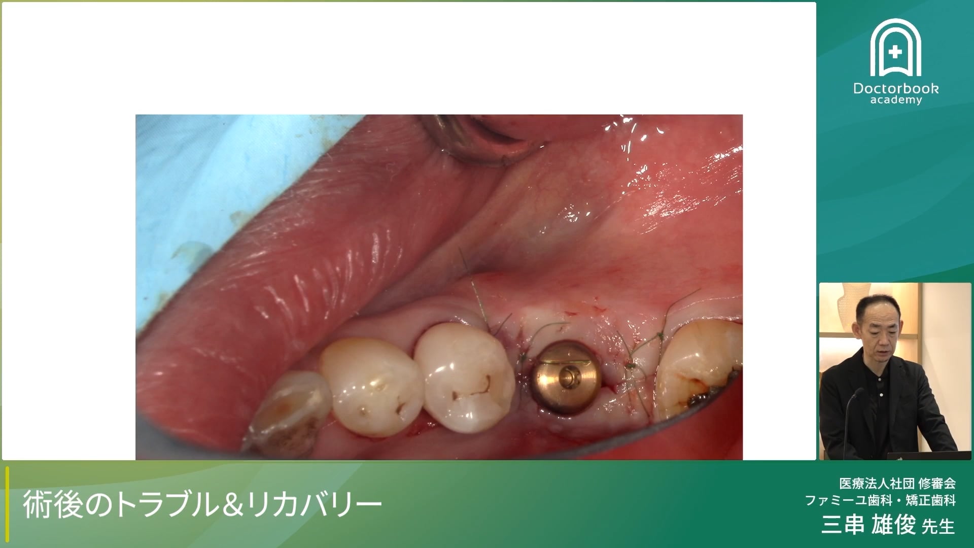 臨床知見録_インプラント周囲炎_患者由来リスク（喫煙）