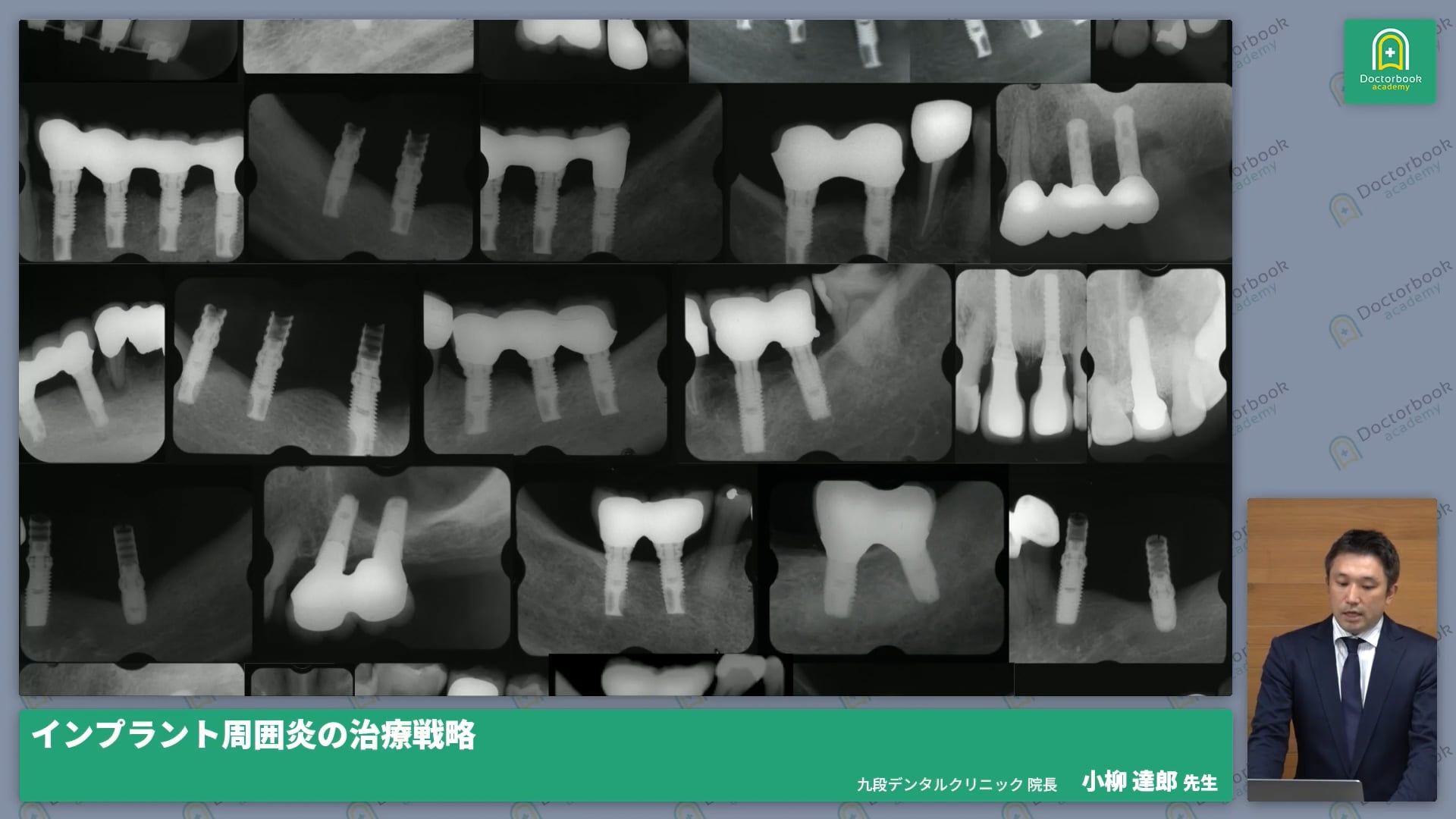臨床知見録_インプラント周囲炎_インプラント周囲炎とは？