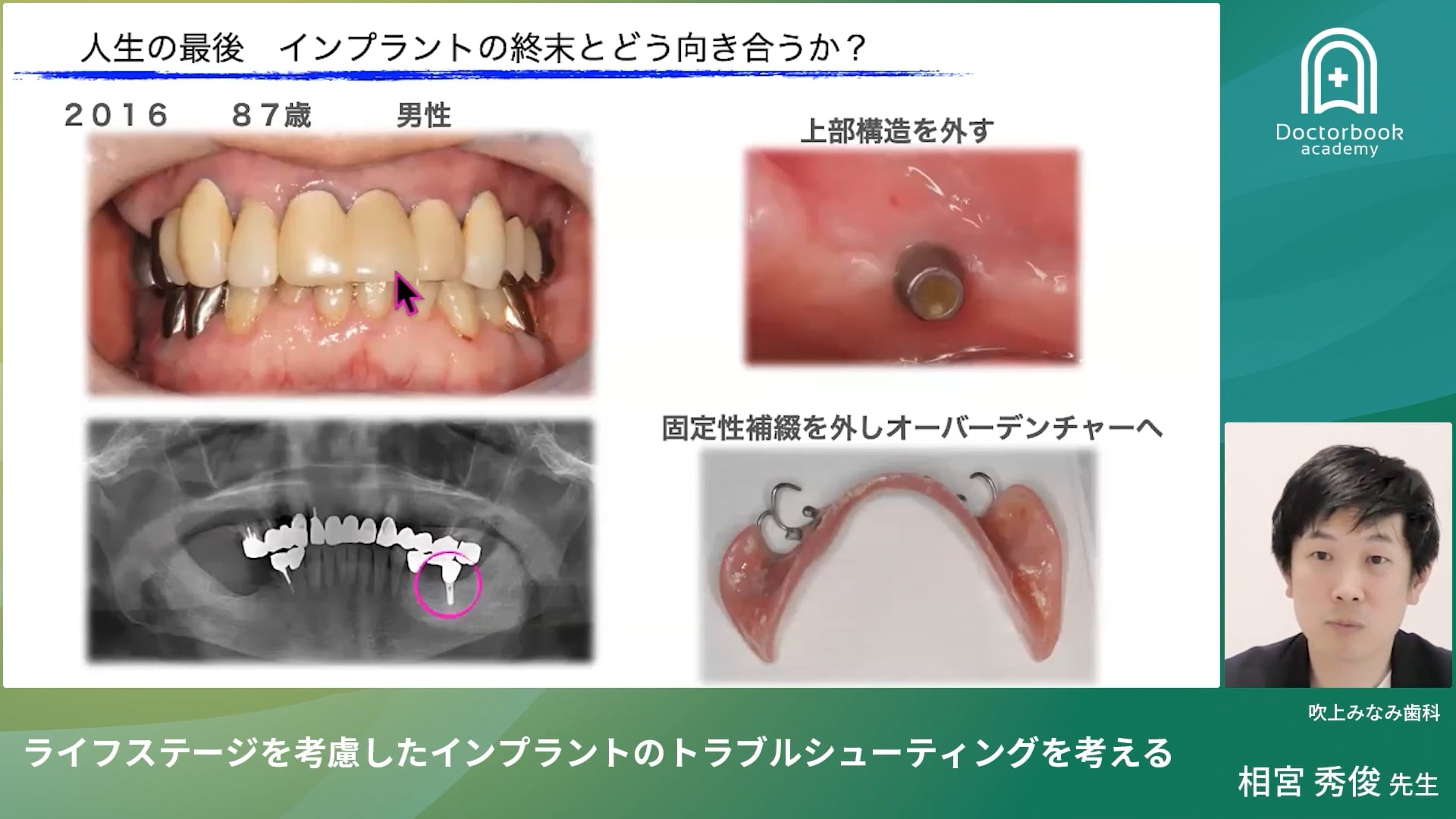 臨床知見録_インプラント周囲炎_撤去判断の実際