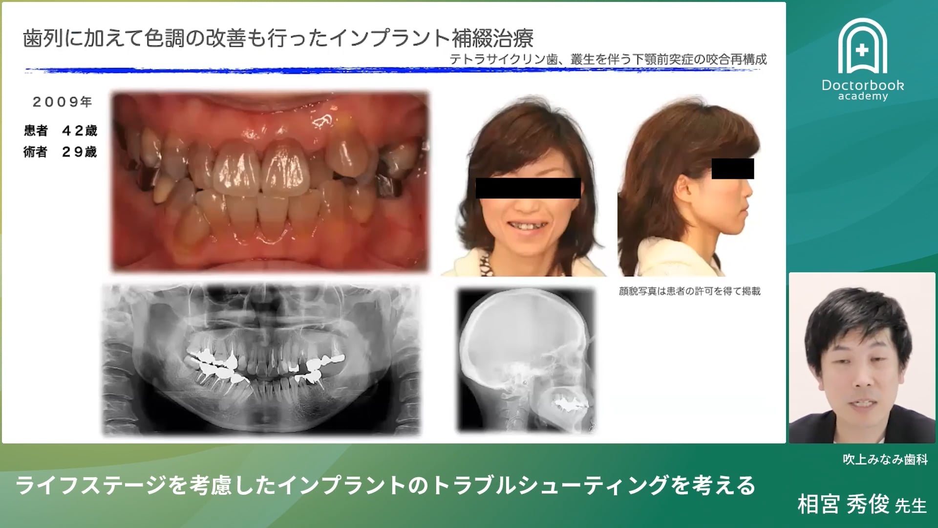 臨床知見録_インプラント周囲炎_撤去と再埋入の考え方