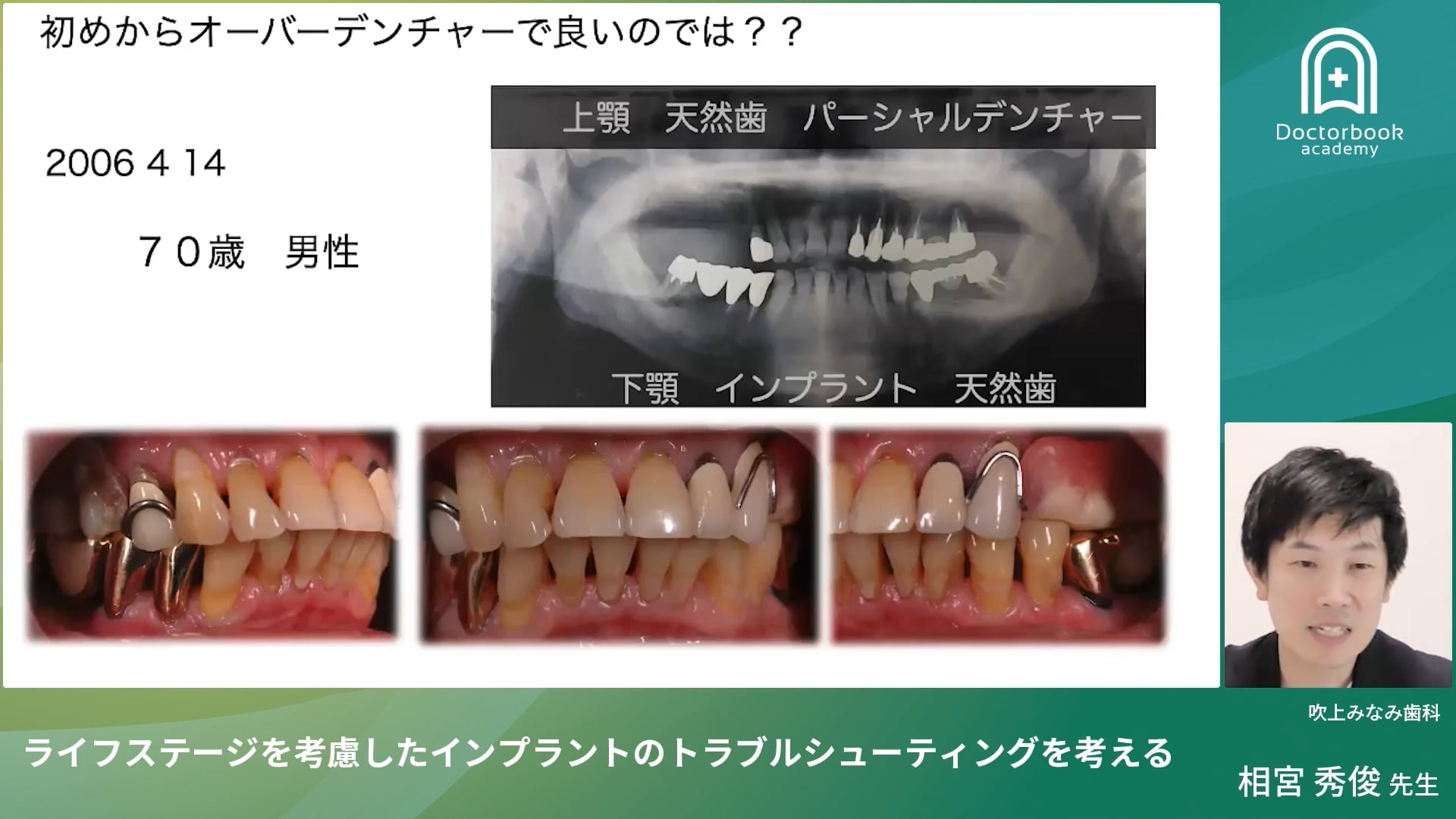 臨床知見録_インプラント周囲炎_再介入・オーバーデンチャーへの移行