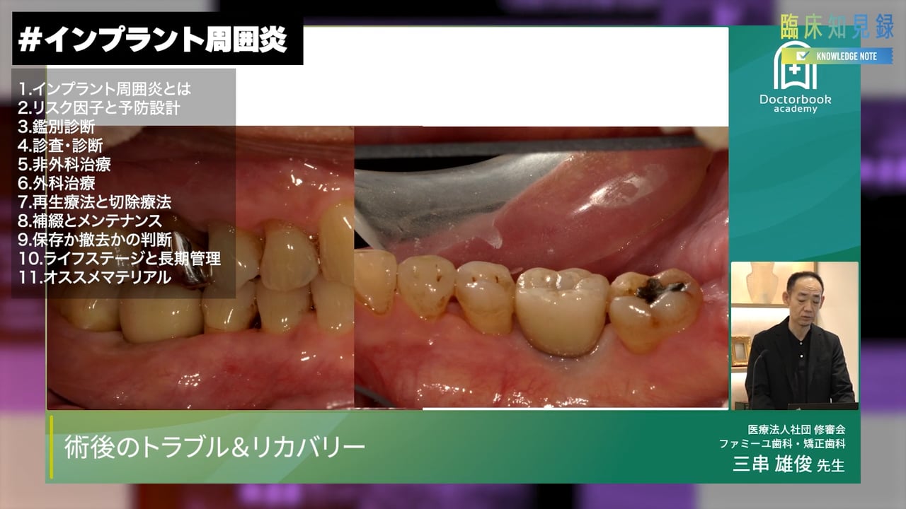臨床知見録_インプラント周囲炎_CM