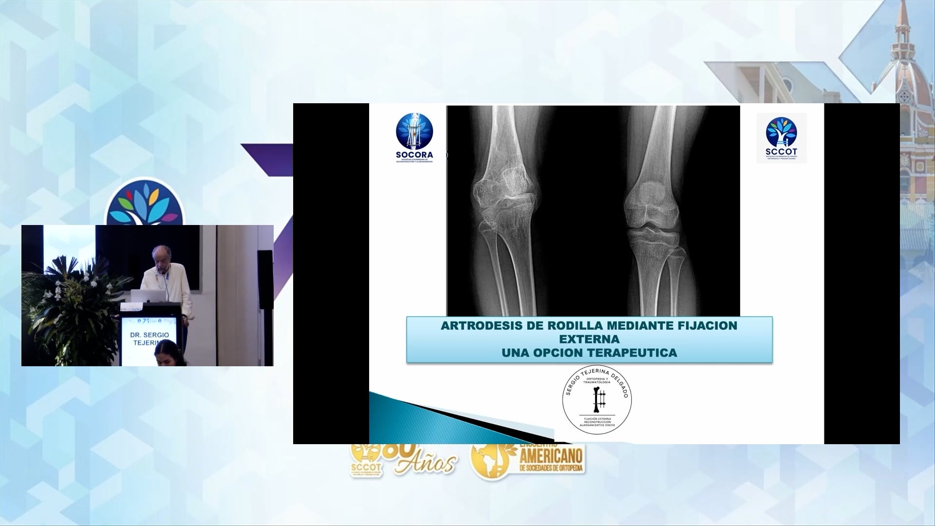 Artrodesis de Rodilla con Fijación Externa