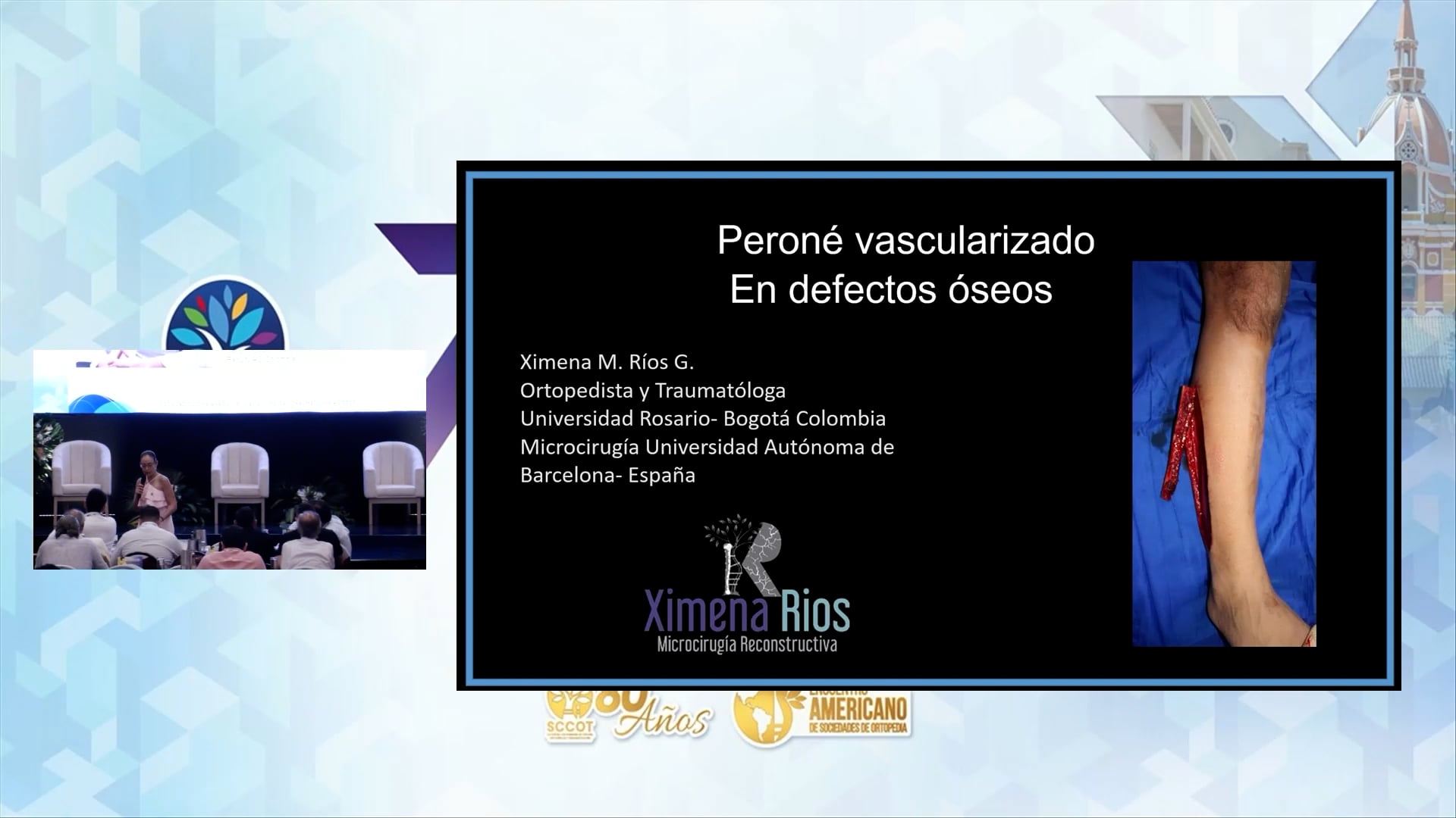 Peroné Vascularizado: Técnica y Aplicaciones