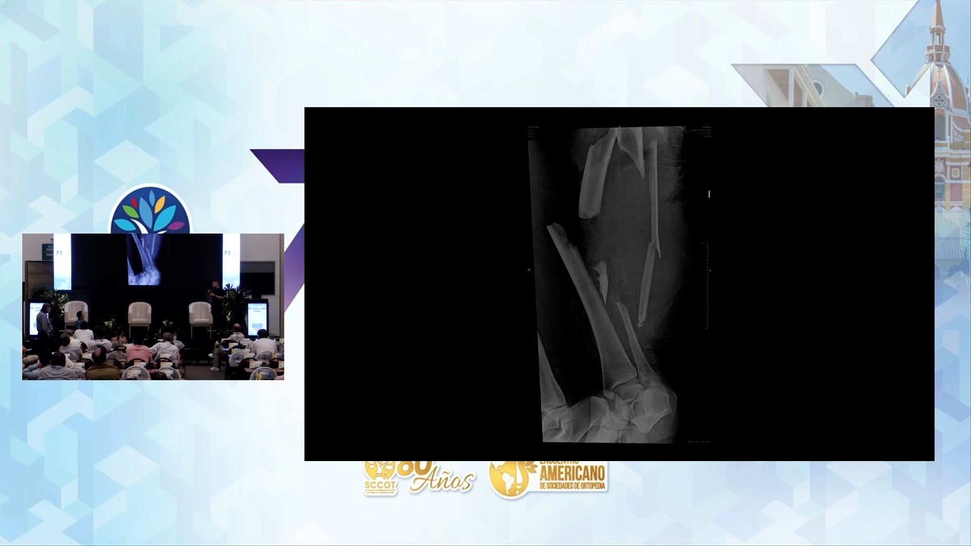 Manejo de Fracturas Complejas y Tejidos Blandos