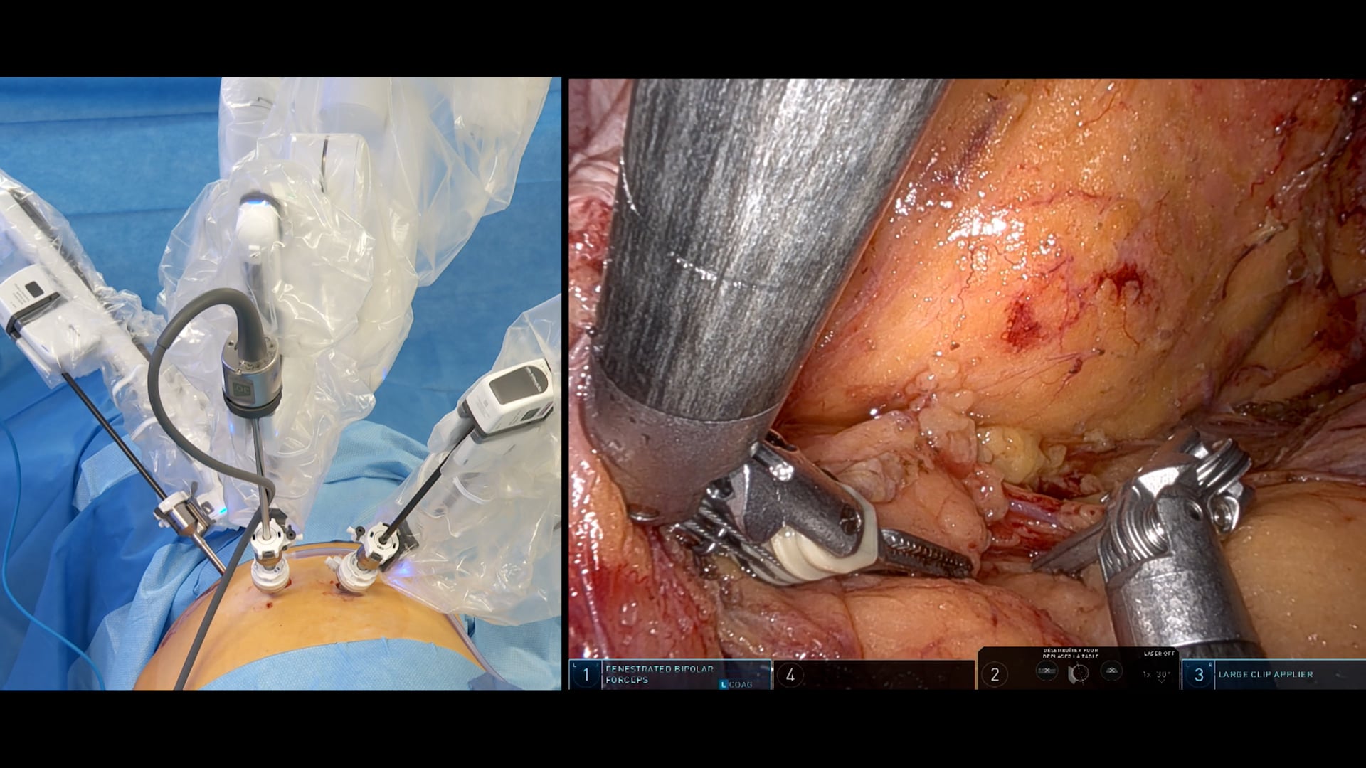 Robotic left adrenalectomy for adrenal oncocytic neoplasms (AON)