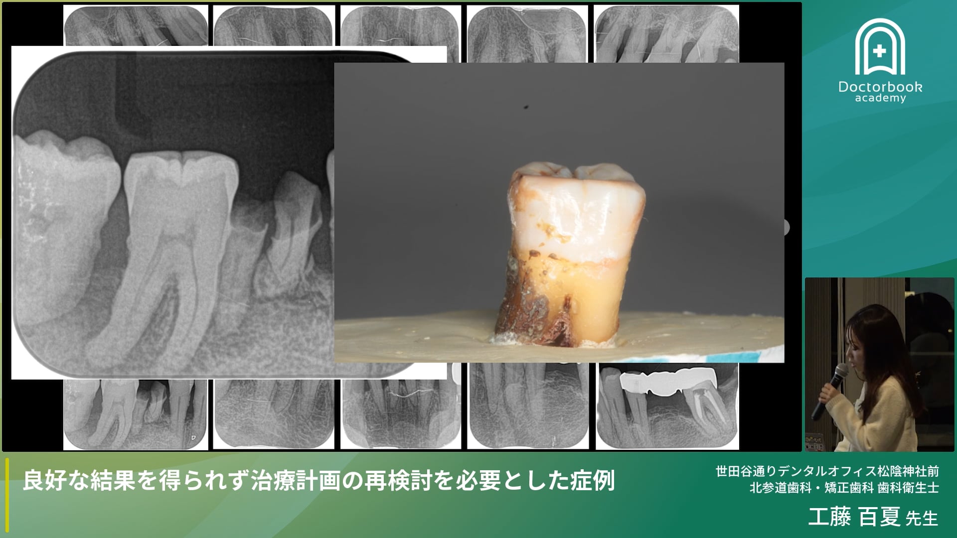 患者さんをメンテナンスへ導く 歯周治療と歯科衛生士の実践的アプローチ