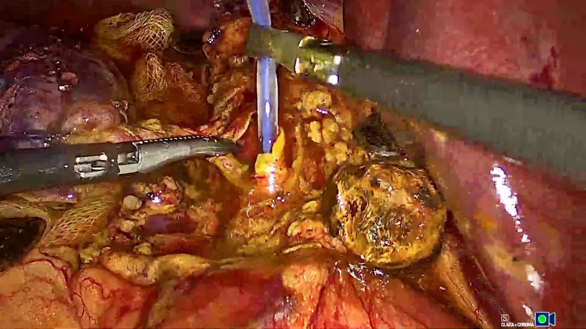 Choledochotomy using a transcholedochal approach for multiple common bile duct stones