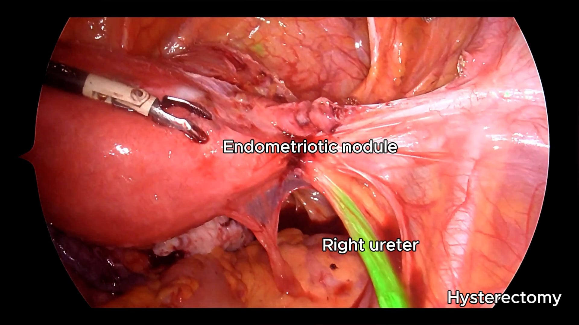Intraureteral indocyanine green (ICG) use in benign gynecologic surgery