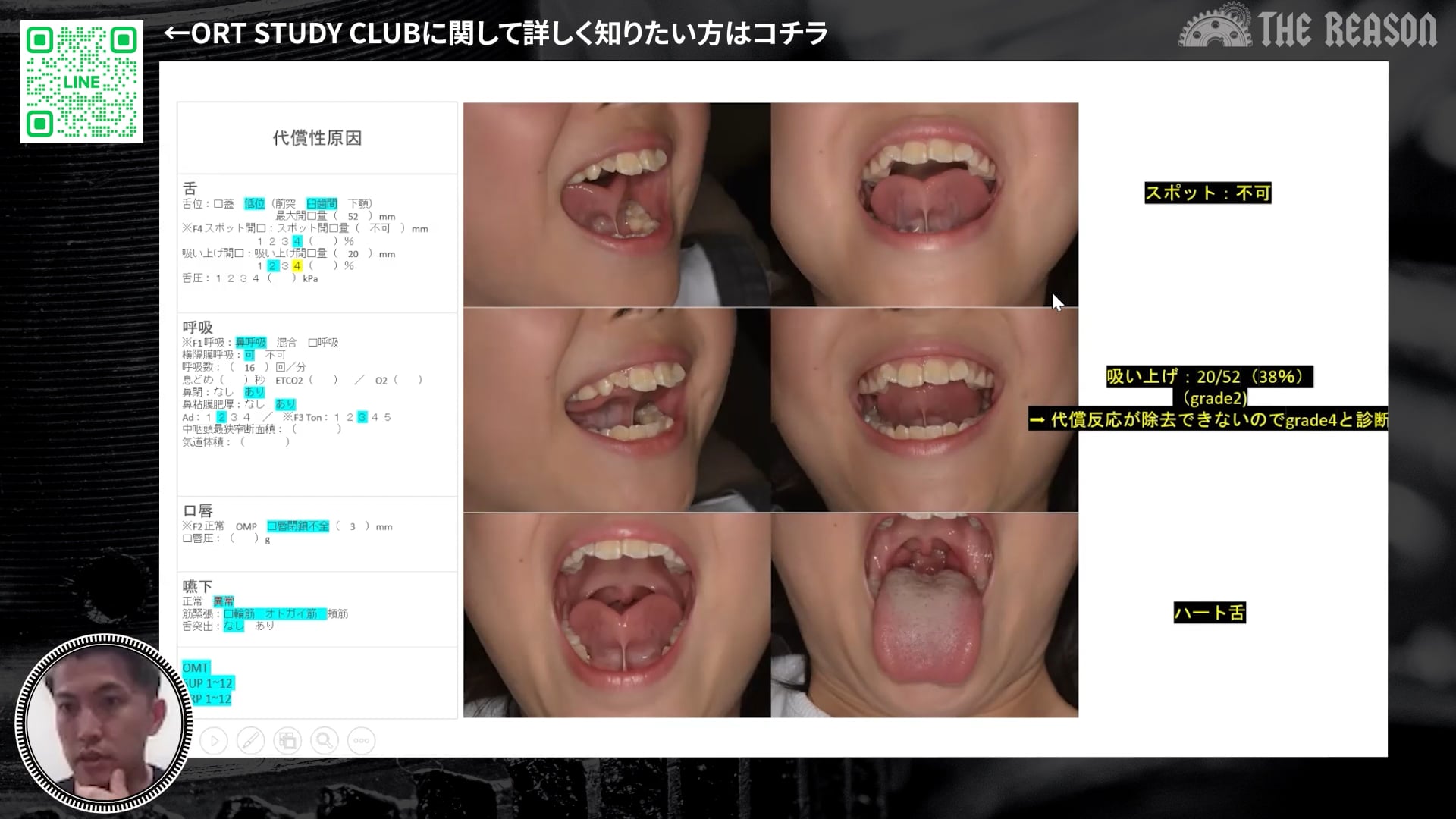 第41回 8歳女児の叢生・上顎狭窄症例から考える原因療法 ― 舌小帯・アレルギー性鼻炎へのアプローチと治療計画 ―