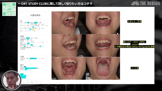 第41回 8歳女児の叢生・上顎狭窄症例から考える原因療法 ― 舌小帯・アレルギー性鼻炎へのアプローチと治療計画 ―