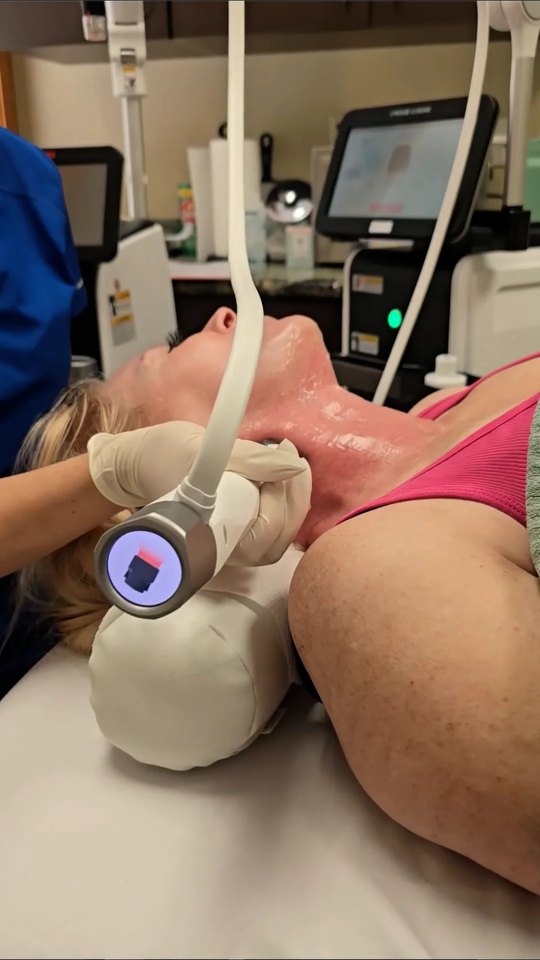 XERF RF Structural Skin Tightening in Chandler, AZ | Lani Laser