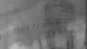 260029_2. RECONSTRUCCIÓN ARTERIAL CON ALOINJERTO ILÍACO EN RETRASPLANTE HEPÁTICO COMPLEJO POR TROMBOSIS DE LA ARTERIA HEPÁTICA: REPORTE DE UN CASO.