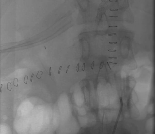 260029_2. RECONSTRUCCIÓN ARTERIAL CON ALOINJERTO ILÍACO EN RETRASPLANTE HEPÁTICO COMPLEJO POR TROMBOSIS DE LA ARTERIA HEPÁTICA: REPORTE DE UN CASO.