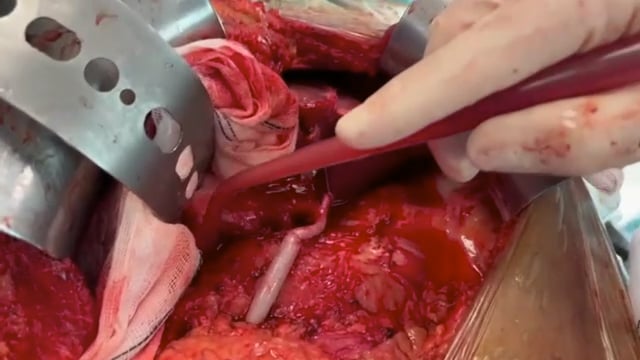 260029_1. RECONSTRUCCIÓN ARTERIAL CON ALOINJERTO ILÍACO EN RETRASPLANTE HEPÁTICO COMPLEJO POR TROMBOSIS DE LA ARTERIA HEPÁTICA: REPORTE DE UN CASO.