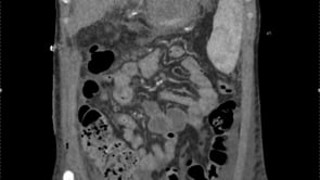 260029_3. RECONSTRUCCIÓN ARTERIAL CON ALOINJERTO ILÍACO EN RETRASPLANTE HEPÁTICO COMPLEJO POR TROMBOSIS DE LA ARTERIA HEPÁTICA: REPORTE DE UN CASO.