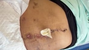 260102_1. ESTRATEGIA DE PREHABILITACIÓN EN GRANDES EVENTRACIONES MEDIANTE TERAPIA COMBINADA DE TOXINA BOTULÍNICA Y NEUMOPERITONEO PROGRESIVO PREOPERATORIO