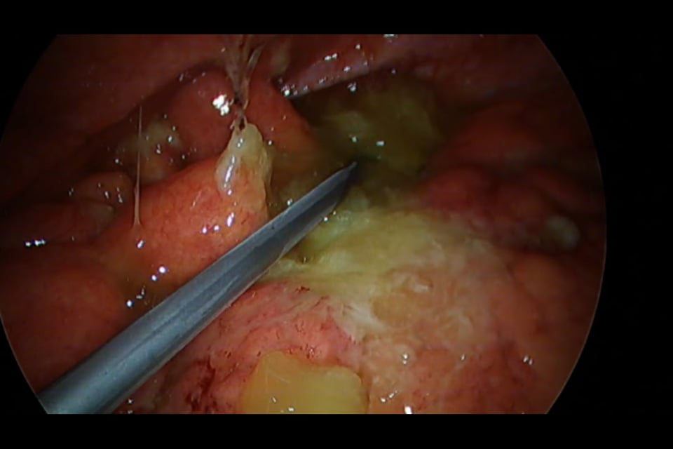 260001. MUCOCELE APENDICULAR