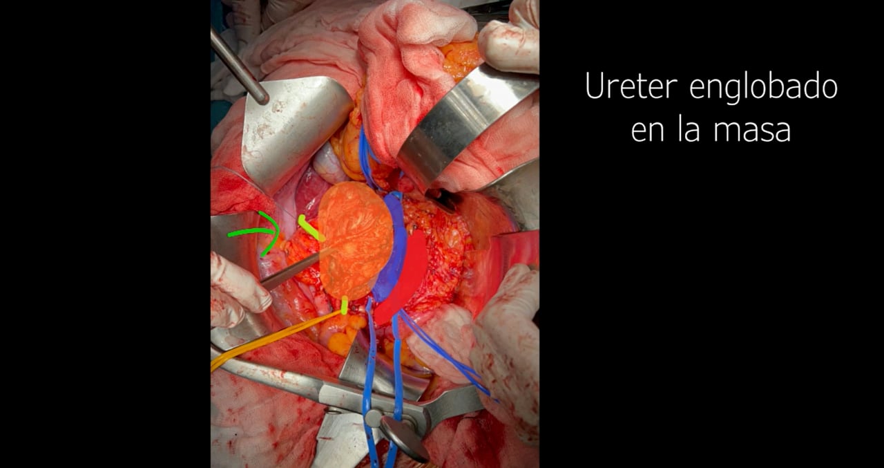 260010. RESECCIÓN RADICAL DE LEIOMIOSARCOMA DE VENA CAVA INFERIOR CON NEFRECTOMÍA DERECHA Y RECONSTRUCCIÓN PROTÉSICA: ESTRATEGIA QUIRÚRGICA.