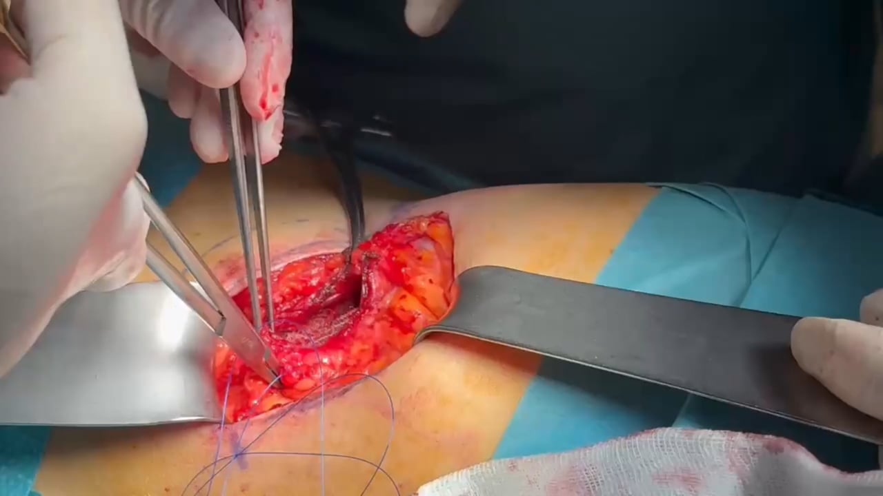 260207_1. DESAFÍO EN LA RECONSTRUCCIÓN DE LA PARED ABDOMINAL LATERAL: HERNIA LUMBAR BILATERAL POST-INJERTO ÓSEO. A PROPÓSITO DE UN CASO.