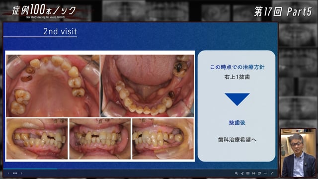 重度歯周炎患者の歯を残すために ― 初診パノラマから考える保存の可能性と治療戦略 ― #6【8月23日までD+,みんプレ会員視聴無料】