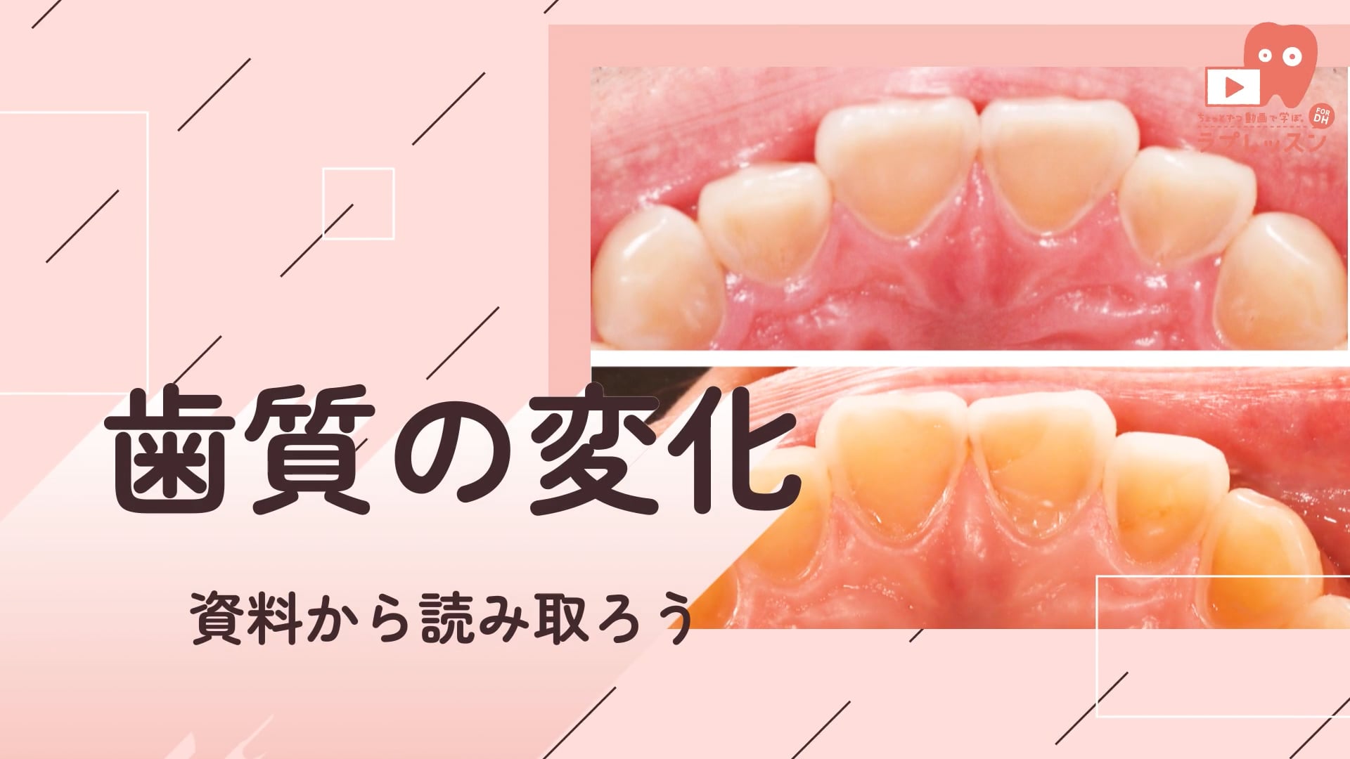 03.歯質の変化