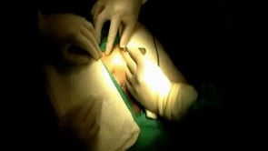DENERVACION MICROQUIRURGICA DEL CORDON ESPERMATICO PARA EL TRATAMIENTO DEL DOLOR TESTICULAR CRONICO: ANALISIS DE RESULTADOS