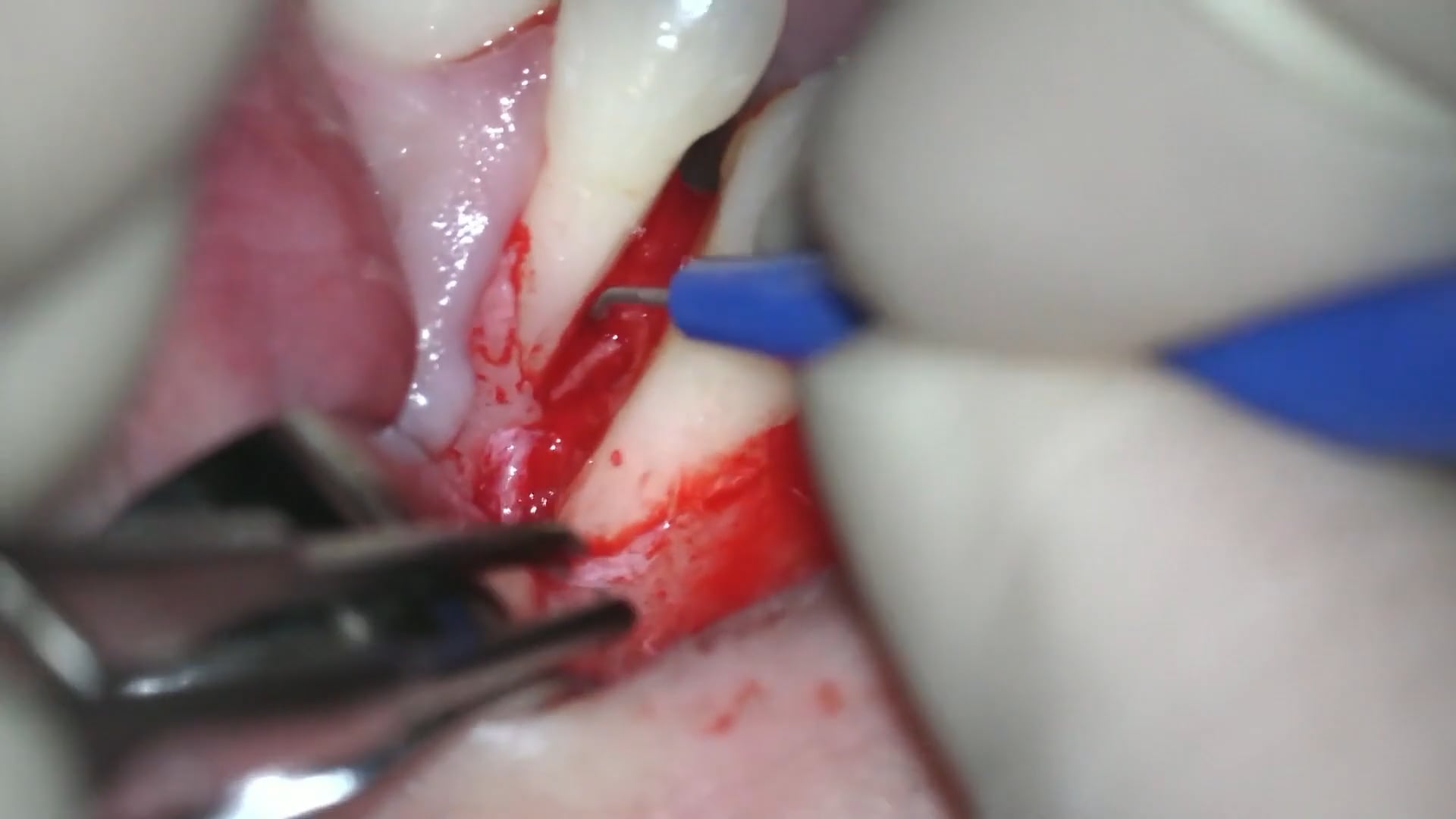 Rizoplastia e Injerto de tejido conectivo