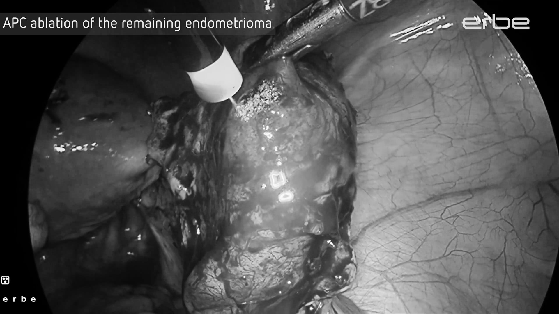 APC Ablation of ovarian endometrioma using APCapplicator