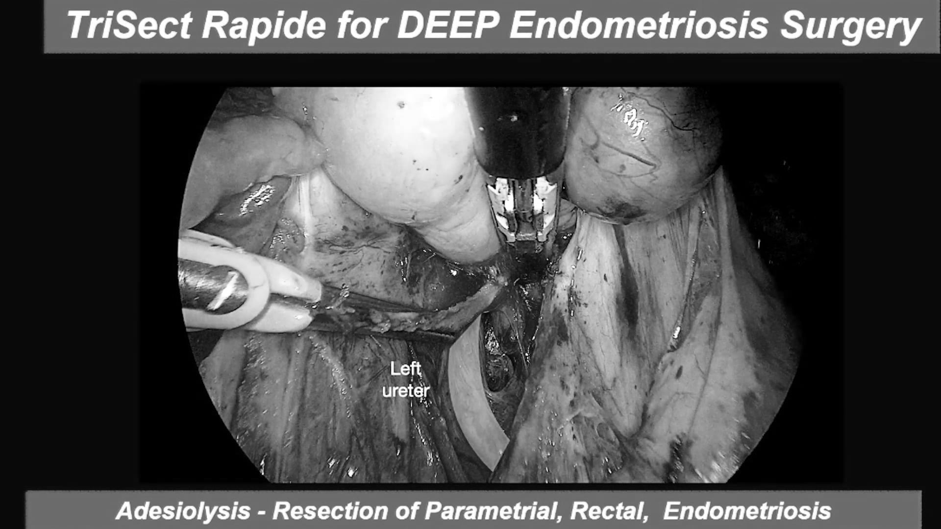 Benefits of TriSect rapide® for treatment of deep infiltrating endometriosis (DIE)