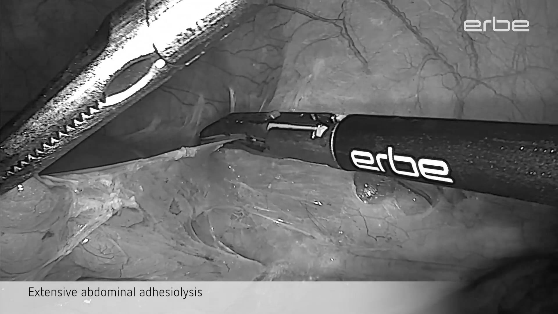 Electrosurgical adhesiolysis and dissection of endometriotic lesions in case of DIE using TriSect rapide®