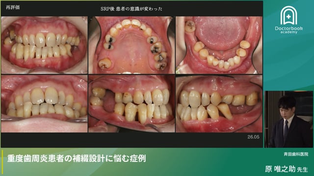 重度歯周炎患者の補綴設計に悩む症例（原 唯之助先生）