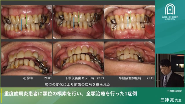 重度歯周炎患者に顎位の模索を行い、全顎治療を行った1症例（三神 亮先生）