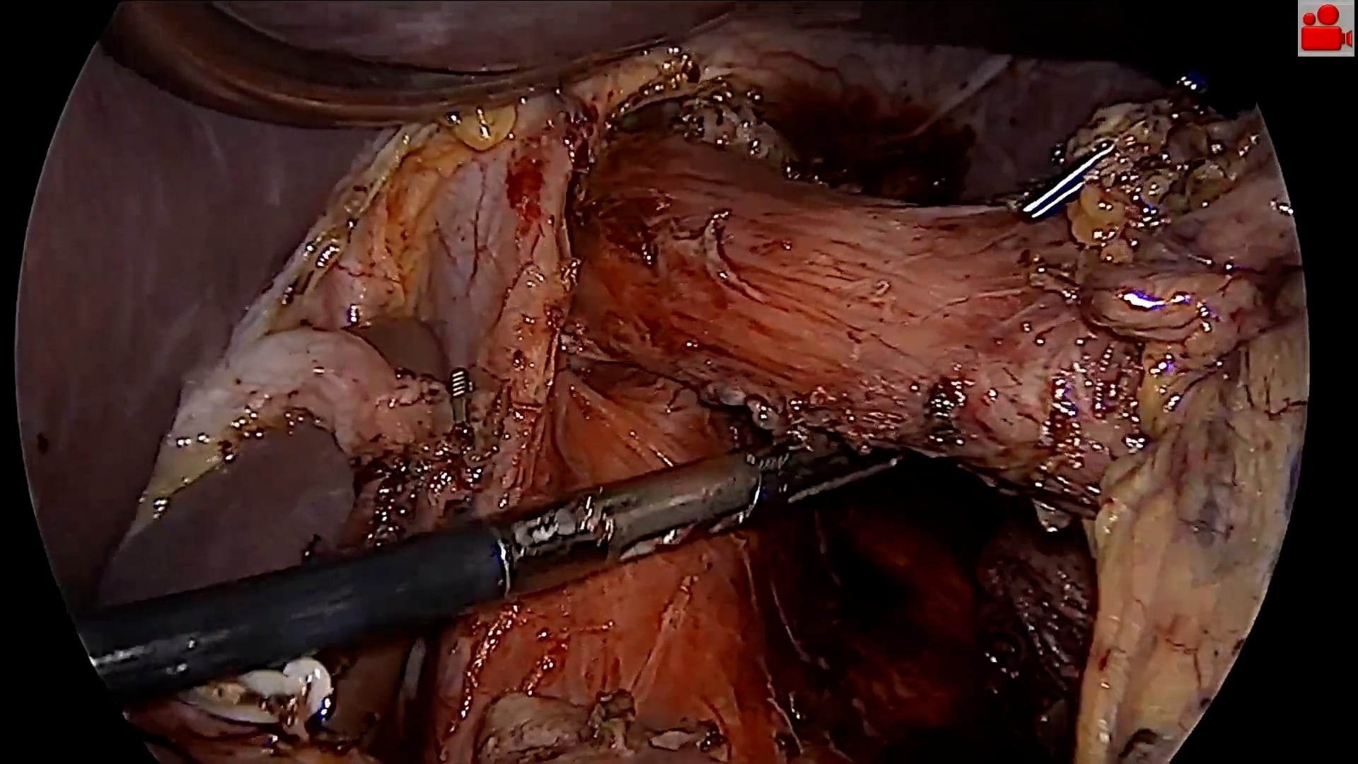 Laparoscopic total gastrectomy with D2 lymphadenectomy for gastric cancer with replaced left hepatic artery 