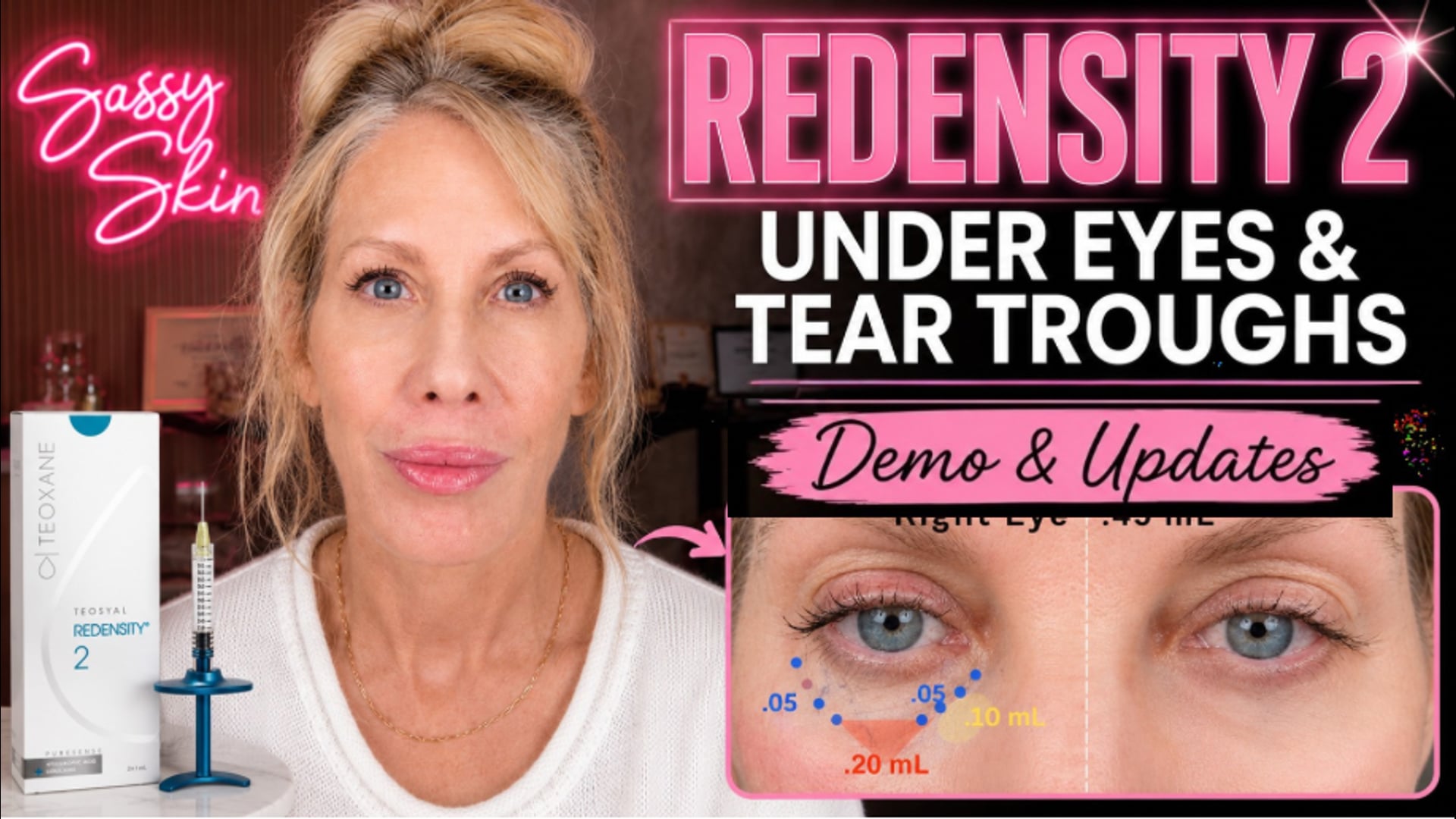 Redensity 2 Under Eyes | Tear Trough Filler, Anatomy & Technique