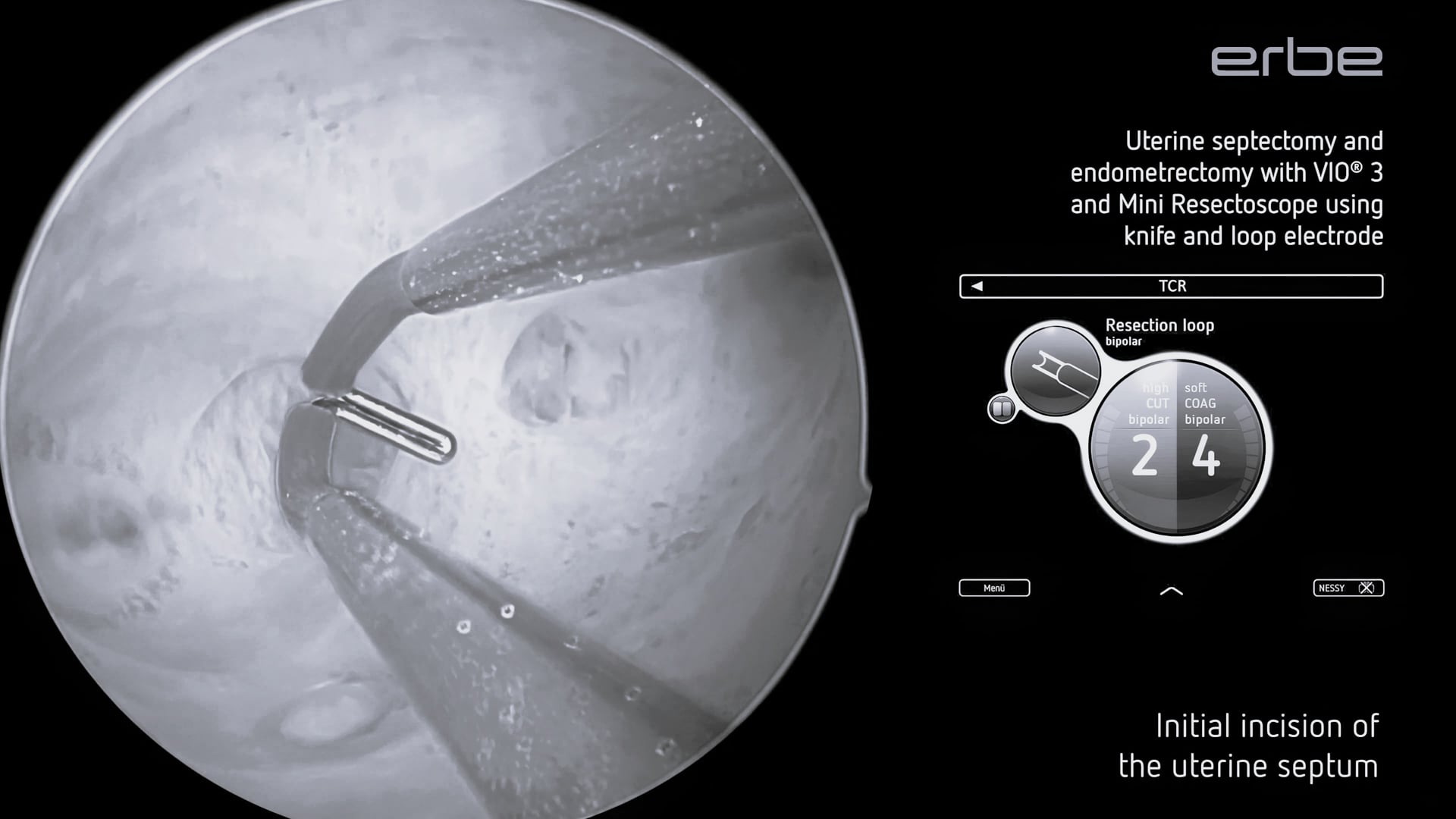 Uterine septectomy and endometrectomy with VIO® 3 and Mini Resectoscope using knife and loop electrode