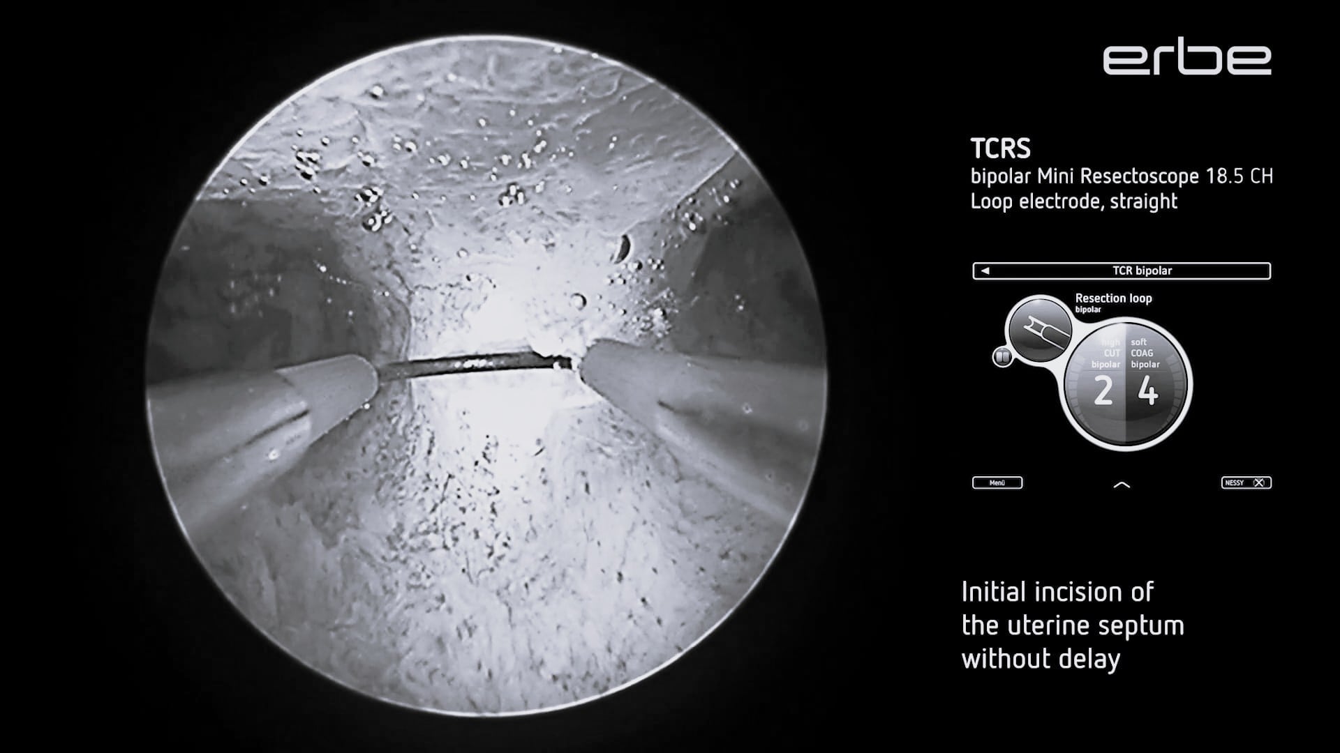 Hysteroscopic transcervical resection of uterine septum (TCRS) using the bipolar 18.5 CH Mini Resectoscope with VIO® 3