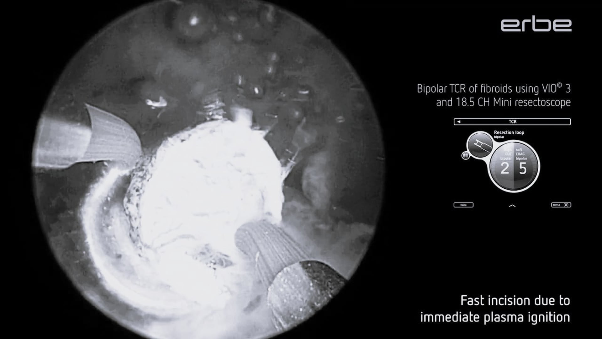 Bipolar transcervical resection of fibroids (TCRF) with VIO® 3 and 18.5 CH Mini resectoscope. Imaged by VIRON 1 System.